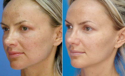 Laser Peel Before & After Tampa Bay