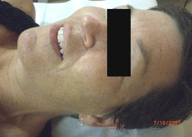 After - LaserSpa of Tampa Bay