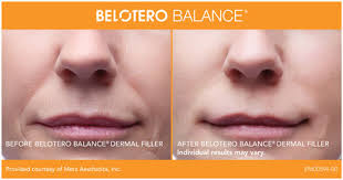 Botox before and after