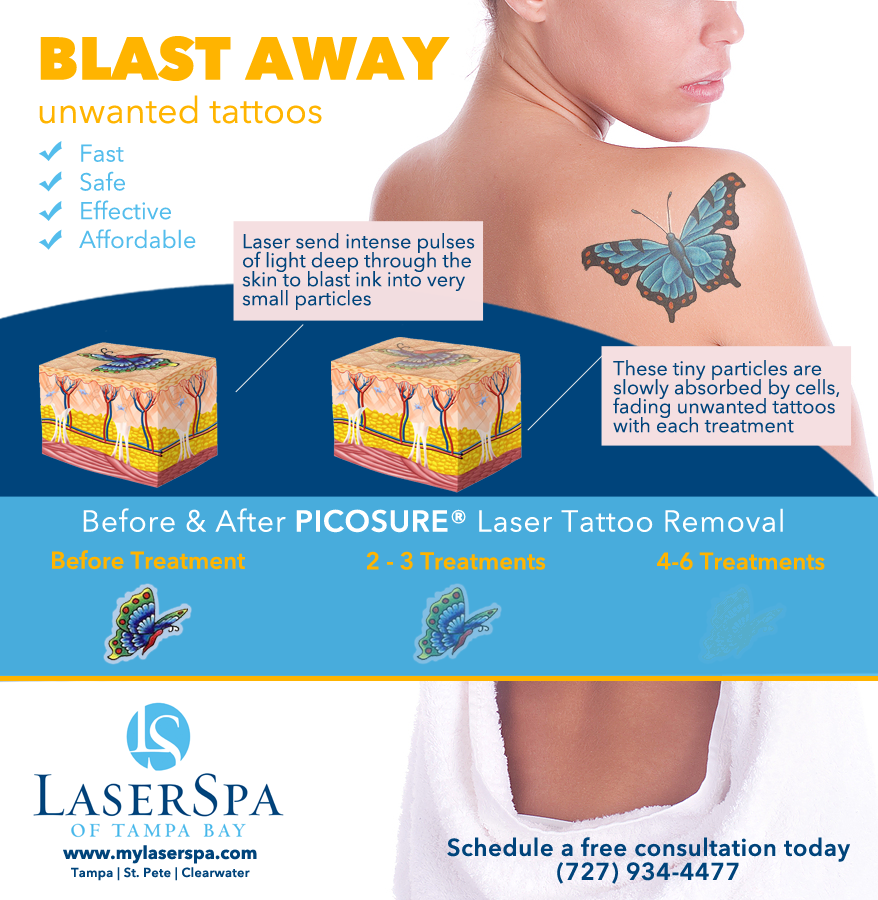 laser tattoo removal how to