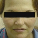 Photofacial Before & After