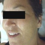 Photofacial Before & After