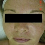 Photofacial Before & After