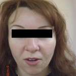 Photofacial Before & After
