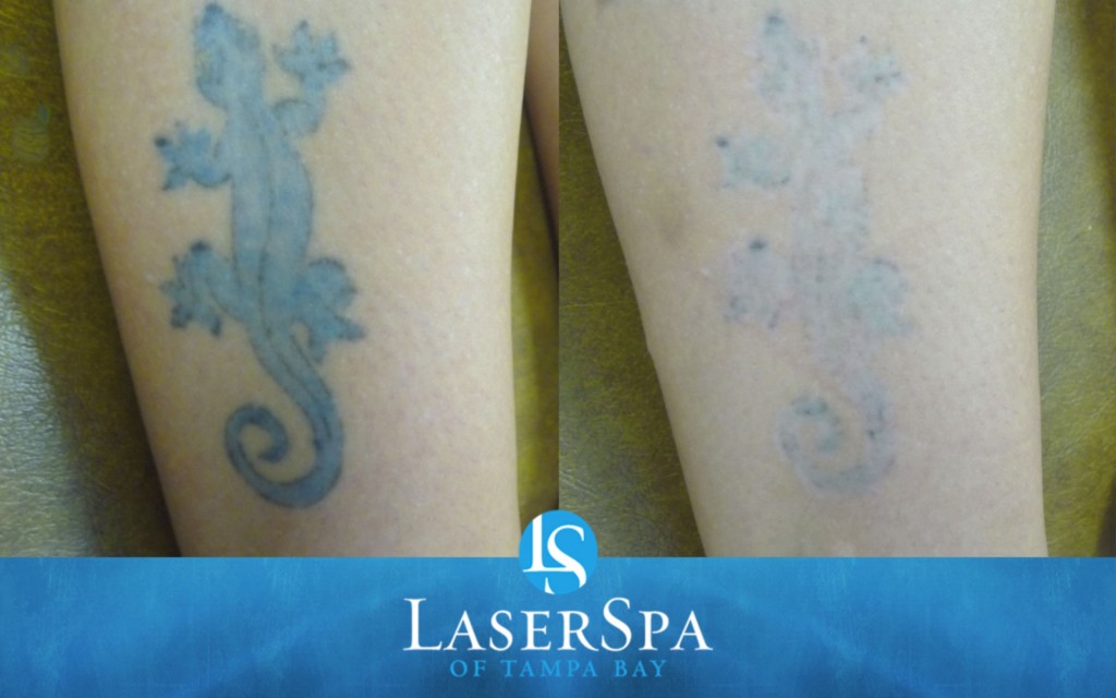 Tattoo Removal Before and After - Results May Vary