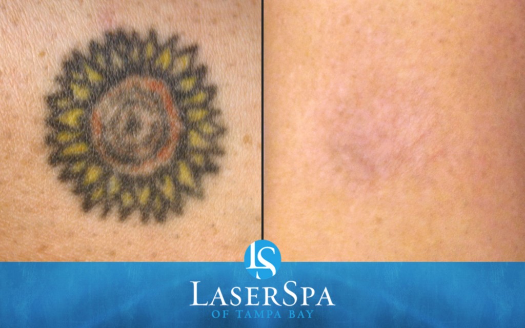 Tattoo Removal Before and After - Results May Vary