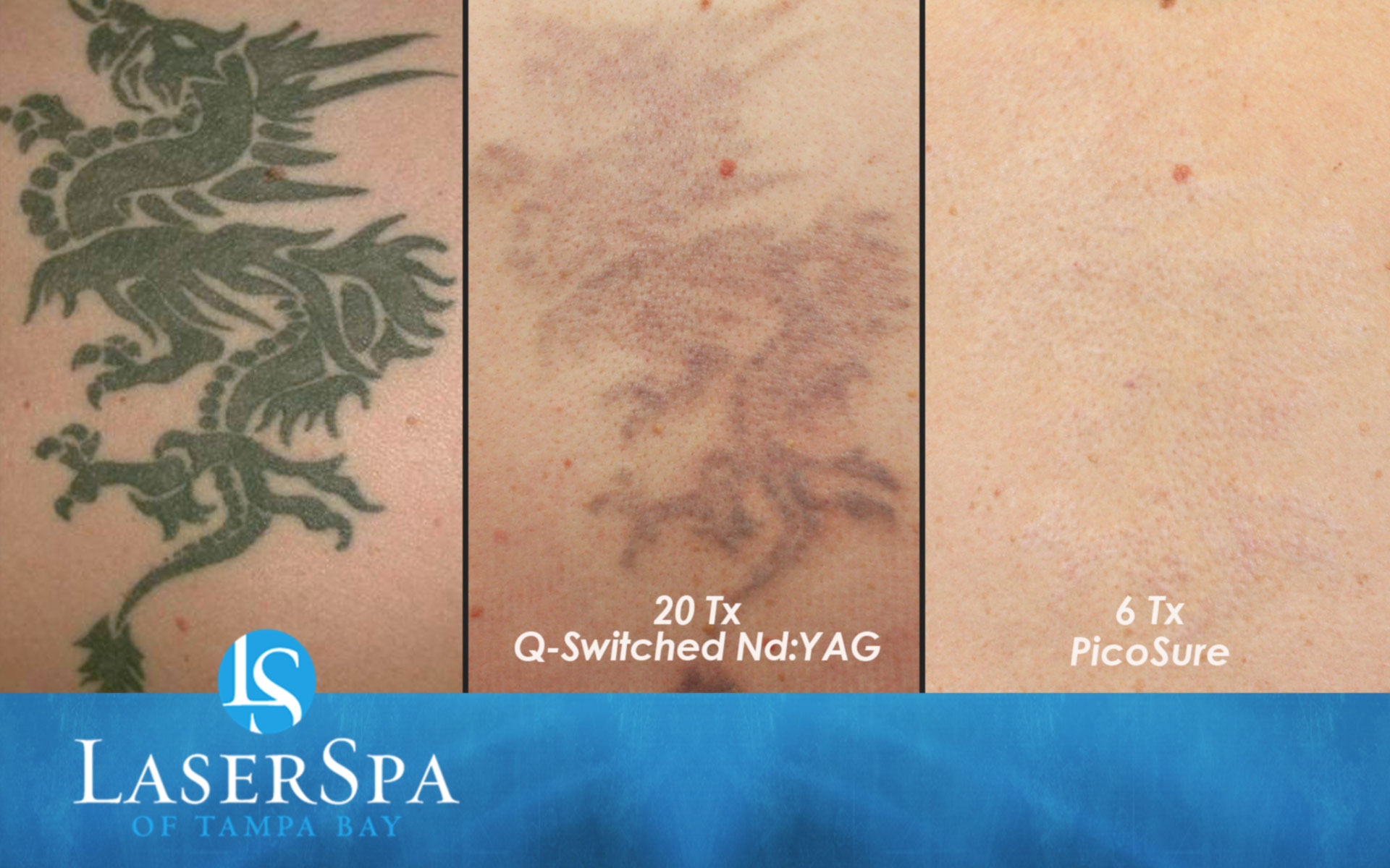 Laser Tattoo Before & After