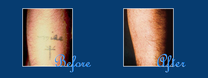 Picosure Tattoo Removal | LaserSpa of Tampa Bay