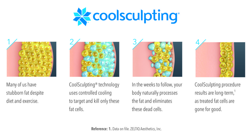 CoolSculpting procedure results