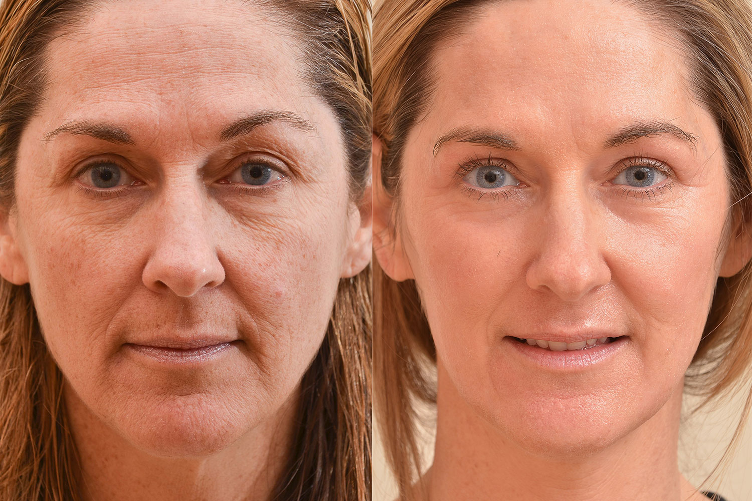 How Much Is Laser Skin Resurfacing Uk