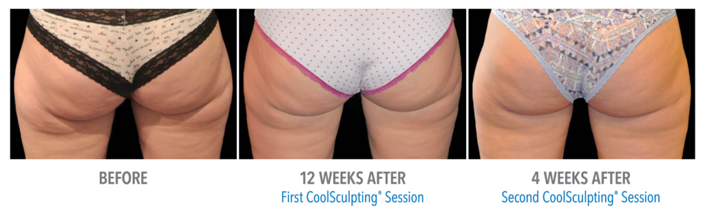 CoolSculpting Before and After Tampa Bay