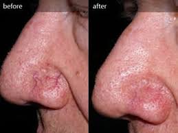 Laser Vein Treatment Before & After Tampa Bay