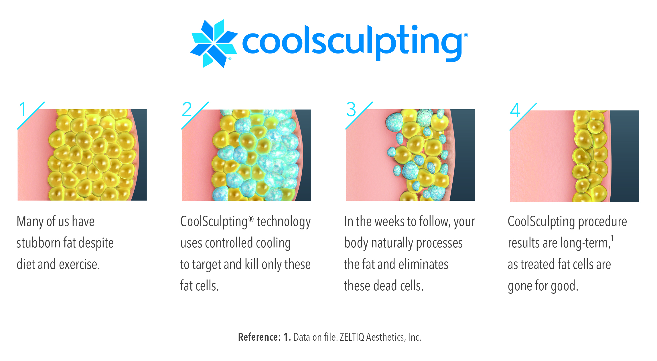 CoolSculpting Odessa - Odessa CoolSculpting - CoolSculpting near me - Florida