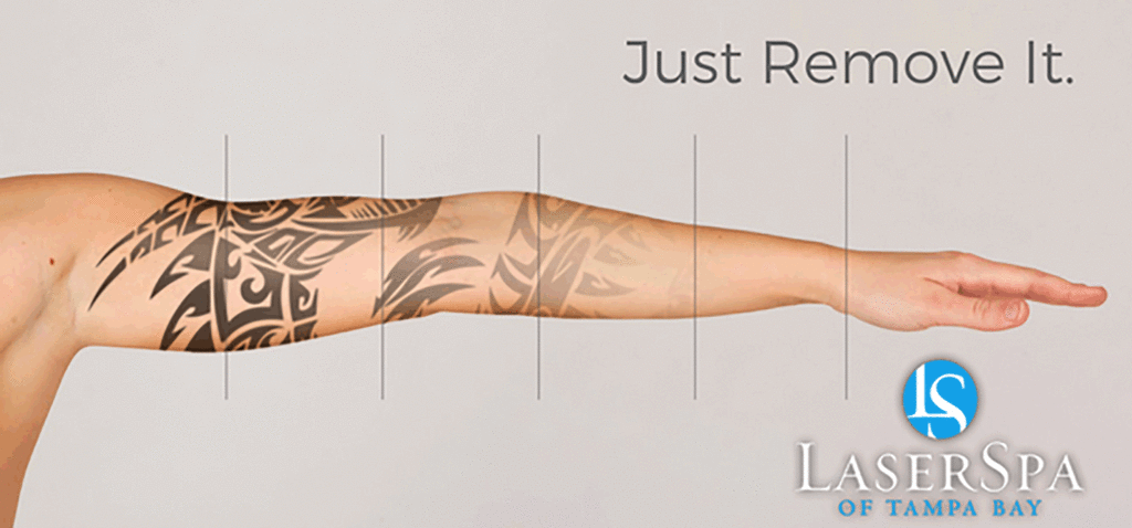 Laser Tattoo Removal Near Me - Laser Tattoo Removal New Port Richey - New Port Richey Laser Tattoo Removal - Florida