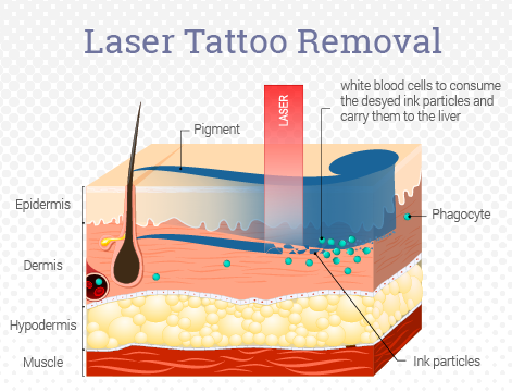 laser tattoo Removal