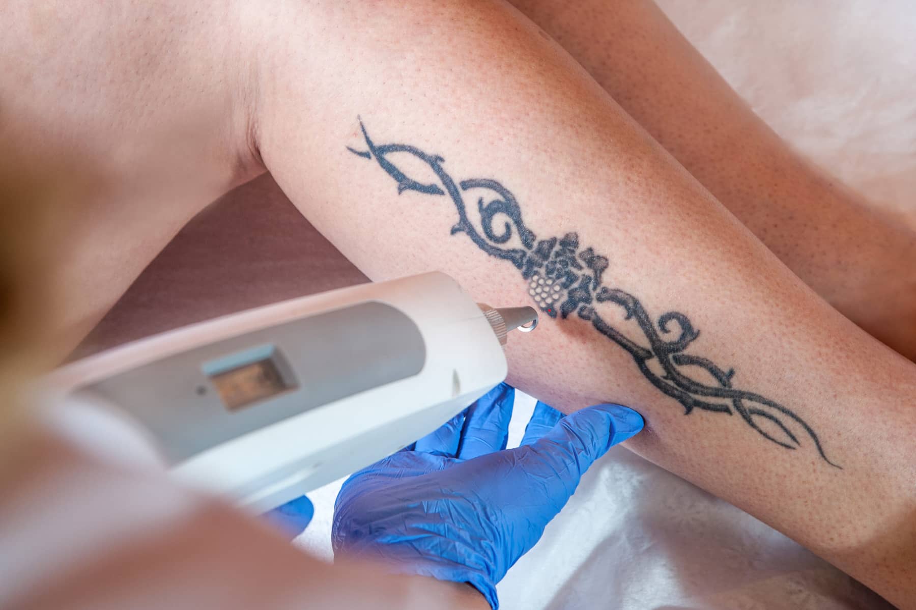Laser Tattoo Removal - Remove Unwanted Tattoos | LaserSpa of Tampa Bay